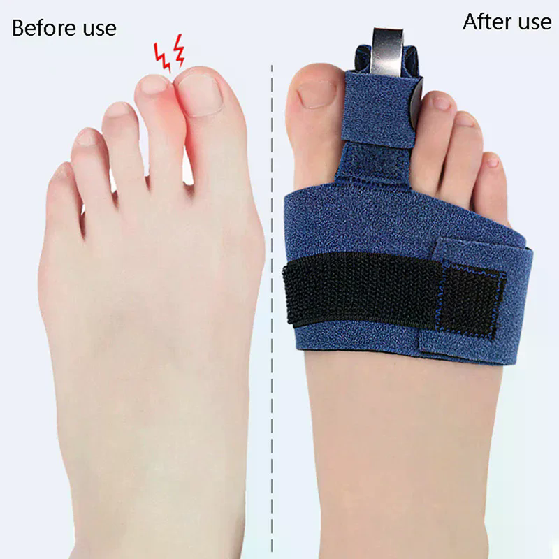 1Pcs Toe Corrector Toe Fractur - Ankle Brace Sock のレビューと価格